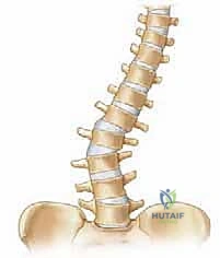 التخطيط الجراحي لعملية الجنف