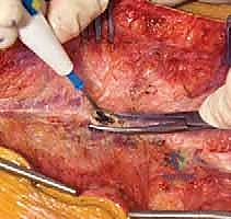 إجراء الشق الجراحي والتعرض العظمي