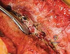 إدخال البراغي العنيقية بدقة في الفقرات