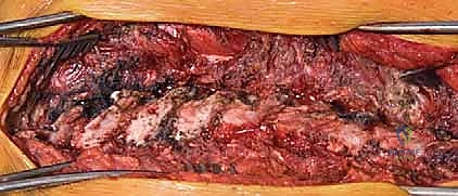 التعرض الخلفي للعمود الفقري لتصحيح الجنف: دليل شامل للمرضى مع الأستاذ الدكتور محمد هطيف