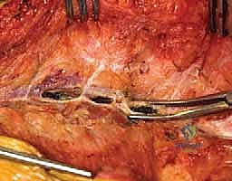 صورة توضيحية لـ التعرض الخلفي للعمود الفقري لتصحيح الجنف: دليل شامل للمرضى مع الأستاذ الدكتور محمد هطيف