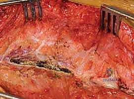 تحرير المفاصل الوجيهية للفقرات