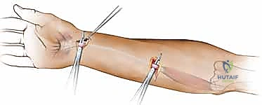إدخال قضيب السيليكون الطبي لإنشاء الغمد الجديد