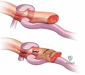 خياطة الطعم الوتري بقضيب السيليكون استعداداً للسحب