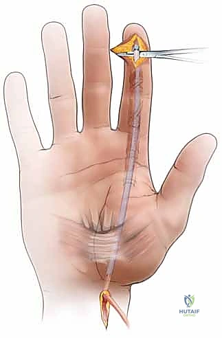 استخراج الطعم الوتري من جسم المريض