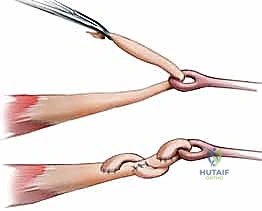 تثبيت الوتر الجديد في السلامية البعيدة للإصبع