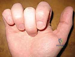 تقنية النسج Pulvertaft لربط الوتر بالعضلة المحركة