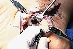 الفحص السريري لتشخيص آلام الكعب المعقدة