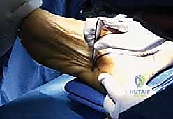 أسباب التهاب اللفافة الأخمصية وتضيق النفق الرصغي