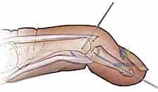 صورة طبية: إصلاح أوتار اليد الباسطة: دليل شامل لتعافي اليد والمعصم والساعد