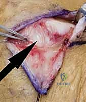 فحص سريري يوضح عدم القدرة على فرد الأصابع