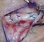 صورة توضيحية لـ إصلاح أوتار اليد الباسطة: دليل شامل لتعافي اليد والمعصم والساعد