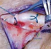 استخدام التصوير الطبي المتقدم لتحديد خطة الجراحة