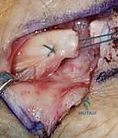 تطبيق جبيرة طبية متخصصة لعلاج إصابات الأوتار