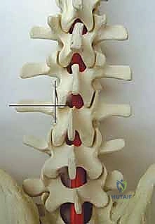 المراقبة العصبية أثناء الجراحة
