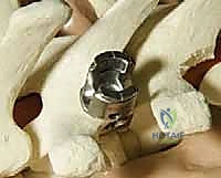 الدمج بين المسامير والخطاطيف