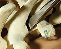 صورة طبية: تصحيح الجنف بالخطاطيف والأوتاد الفقرية: دليل شامل للمرضى مع الأستاذ الدكتور محمد هطيف