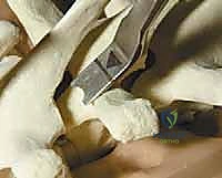 صورة توضيحية لـ تصحيح الجنف بالخطاطيف والأوتاد الفقرية: دليل شامل للمرضى مع الأستاذ الدكتور محمد هطيف