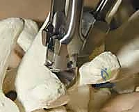 متابعة الأشعة السينية بعد أشهر من العملية