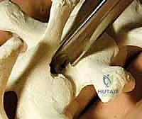 تصحيح الجنف بالخطاطيف والأوتاد الفقرية: دليل شامل للمرضى مع الأستاذ الدكتور محمد هطيف