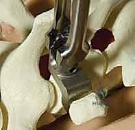 توضيح التشوه الثلاثي الأبعاد للجنف