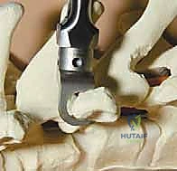 صورة شعاعية توضح نوع الجنف