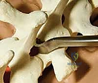 إدخال الأوتاد الفقرية بدقة