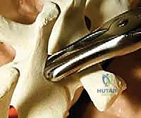 وضع الطعوم العظمية للدمج