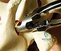 صورة شعاعية للنتيجة النهائية داخل العمليات