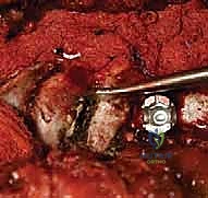 الأشعة النهائية لتأكيد التصحيح