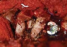 صورة توضيحية لـ تصحيح الجنف بالخطاطيف والأوتاد الفقرية: دليل شامل للمرضى مع الأستاذ الدكتور محمد هطيف