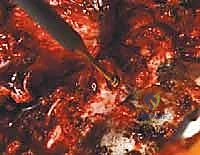 صورة توضيحية لـ تصحيح الجنف بالخطاطيف والأوتاد الفقرية: دليل شامل للمرضى مع الأستاذ الدكتور محمد هطيف