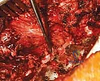 استخدام الخطاطيف في الجراحة