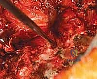 صورة توضيحية لـ تصحيح الجنف بالخطاطيف والأوتاد الفقرية: دليل شامل للمرضى مع الأستاذ الدكتور محمد هطيف