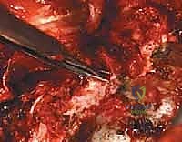 صورة توضيحية لـ تصحيح الجنف بالخطاطيف والأوتاد الفقرية: دليل شامل للمرضى مع الأستاذ الدكتور محمد هطيف