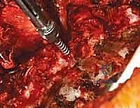 مناورات تصحيح العمود الفقري