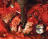 تخطيط جراحي دقيق لتصحيح انحراف العمود الفقري