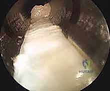 Intraoperative Surgical Step