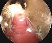 Endoscopic Plantar Fasciotomy: A Masterclass in Minimally Invasive Heel Pain Relief