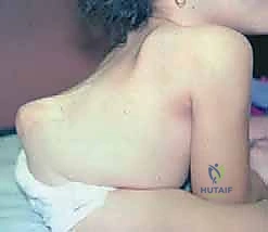 Illustration of kyphectomy in spina - Dr. Mohammed Hutaif