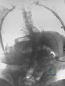 التشوه التشريحي للعمود الفقري