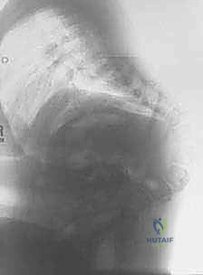 تأثير الحداب على استقامة الطفل