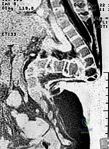فحص وتقييم حالة الحداب قبل الجراحة