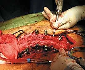 صورة توضيحية لـ جراحة استئصال الحداب للقيلة النخاعية السحائية: دليل الأستاذ الدكتور محمد هطيف في صنعاء