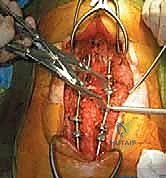 تطور الأعراض الجلدية بسبب الحداب