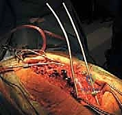 صورة توضيحية لـ جراحة استئصال الحداب للقيلة النخاعية السحائية: دليل الأستاذ الدكتور محمد هطيف في صنعاء