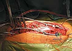 الأستاذ الدكتور محمد هطيف في غرفة العمليات