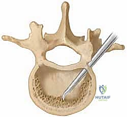 جراحة استئصال الحداب للقيلة النخاعية السحائية: دليل الأستاذ الدكتور محمد هطيف في صنعاء