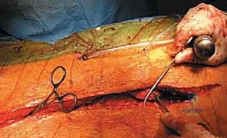 صورة توضيحية لـ جراحة استئصال الحداب للقيلة النخاعية السحائية: دليل الأستاذ الدكتور محمد هطيف في صنعاء