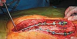 مراحل التثبيت الفقري